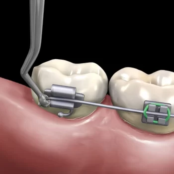 GDC Distal Bending Instrument 75.0mm - Image 4