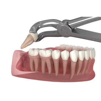 GDC Extraction Forcep Lower Third Molars - 79 Standard - Image 5